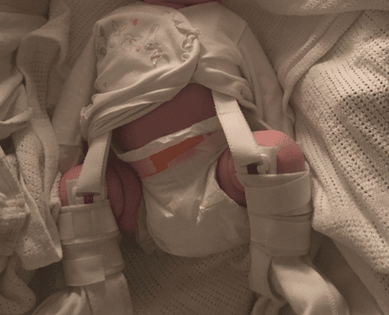 Baby in a Pavlik harness for hip dysplasia.