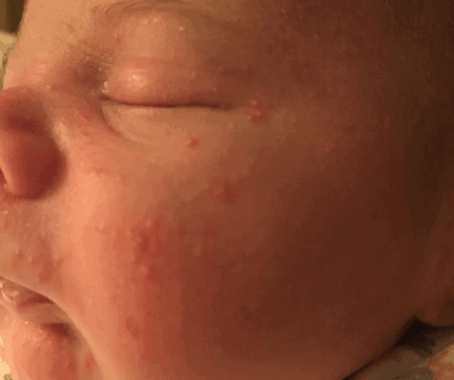 Close-up of a baby's face with rash