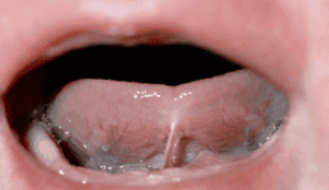 Tongue Ties